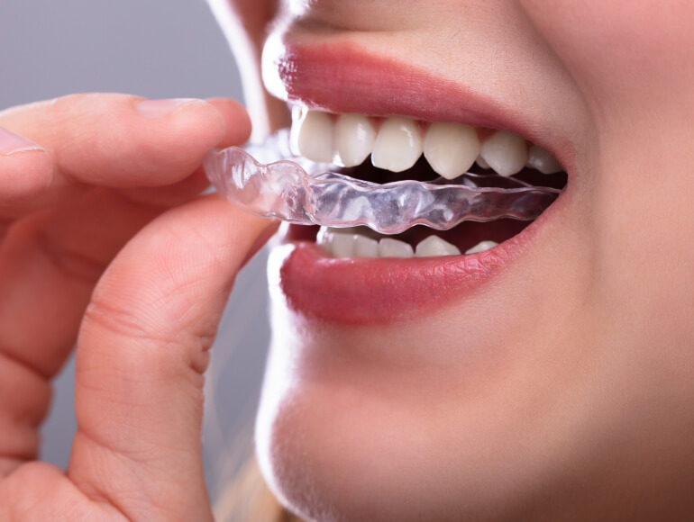 Straighten Your Teeth the Discreet Way