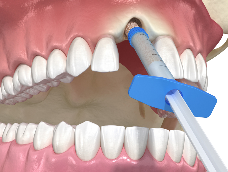 Bone Grafting Services