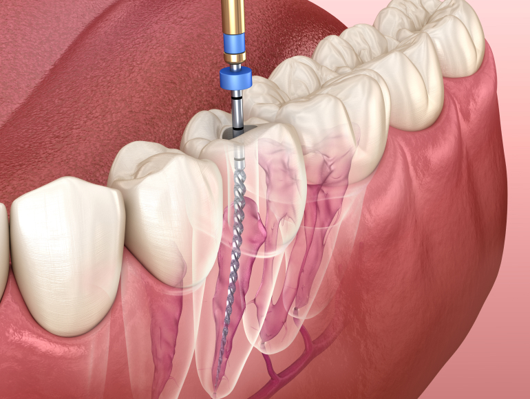 Root Canal Therapy
