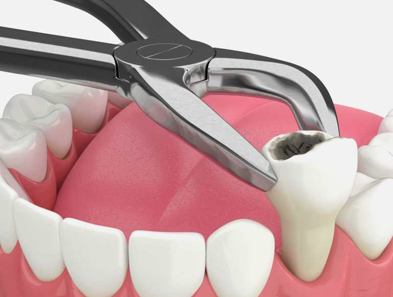 Tooth Extractions
