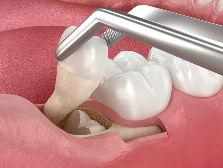 Wisdom Teeth Removal