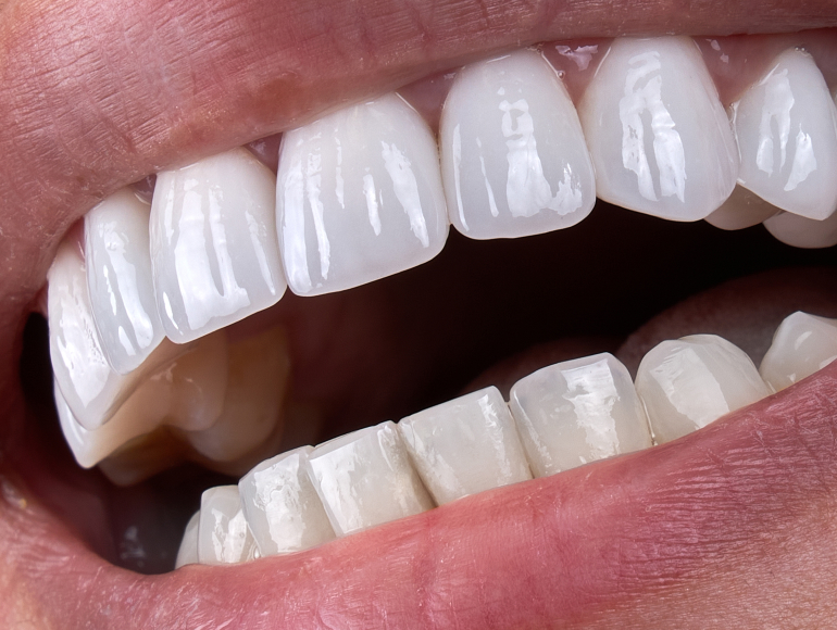 Dental Bonding