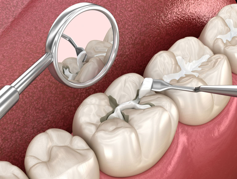 Dental Fillings