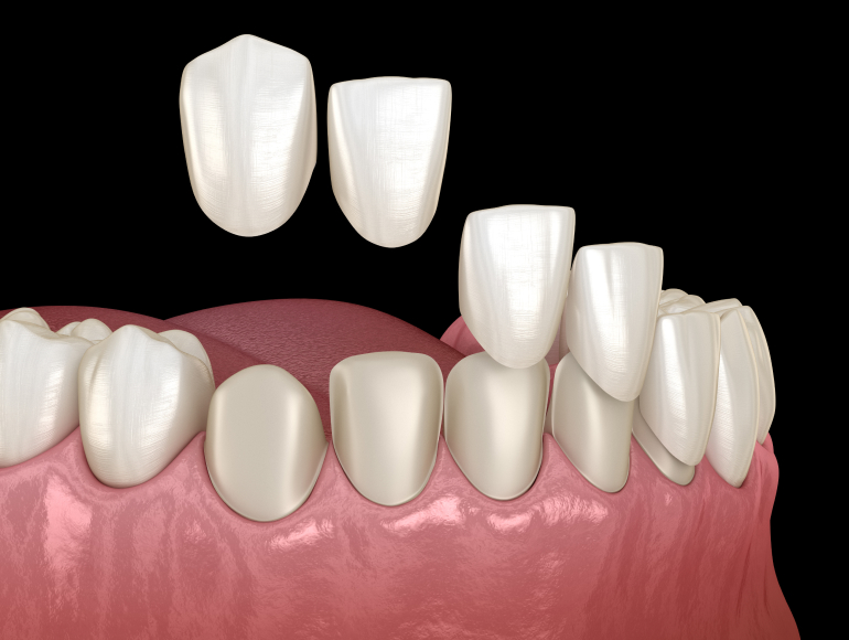 Dental Veneers