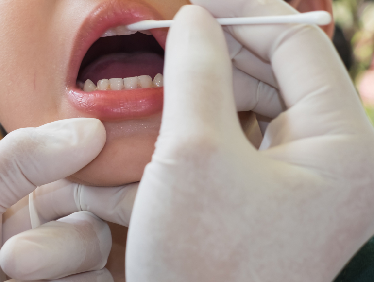 Fluoride Treatment