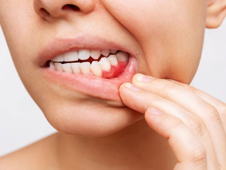 Gum Disease Treatment