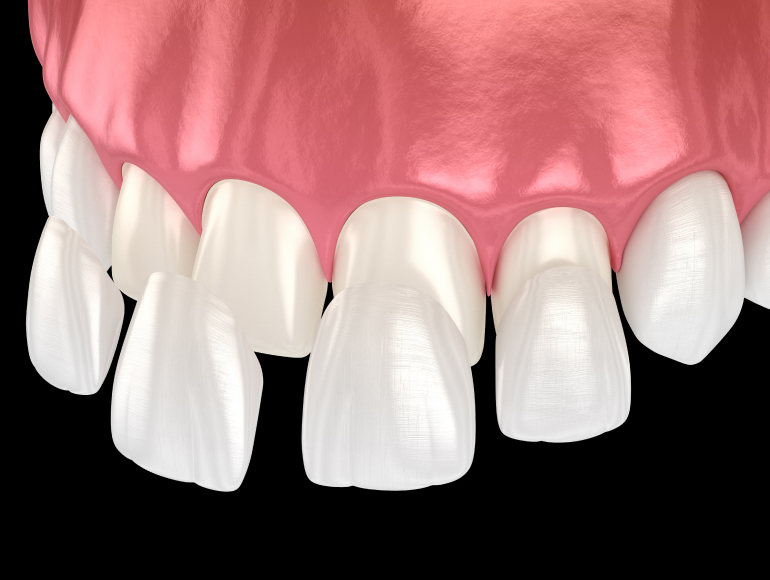 Enhance Your Smile with Custom Dental Veneers