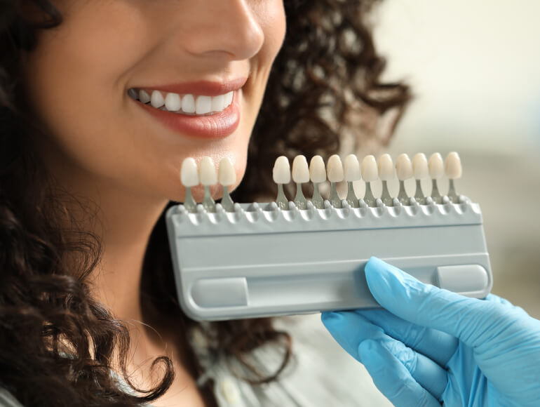 Dental Veneers