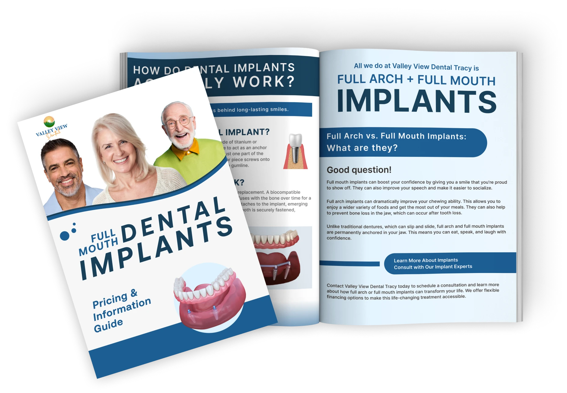 Dental Implant Guide