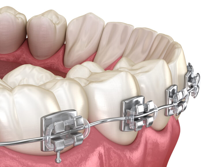 A Reliable & Effective Orthodontic Solution