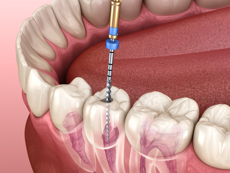 Preserve Your Tooth and Eliminate Pain