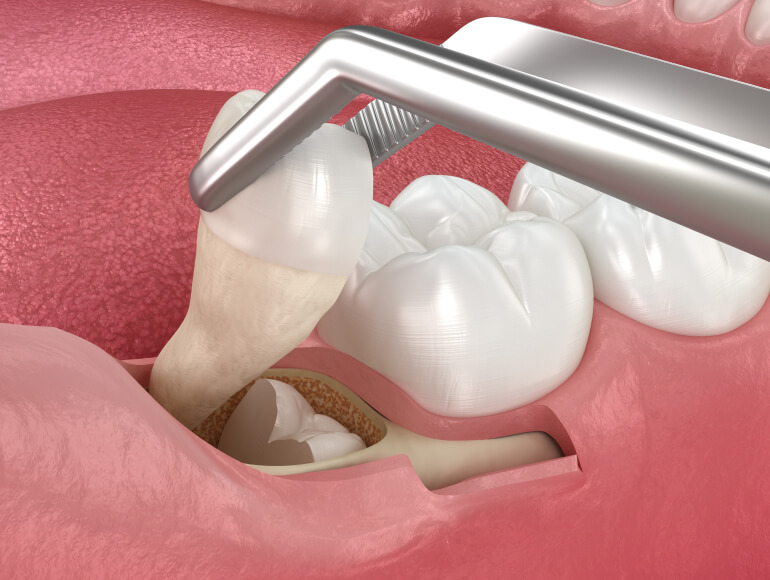 Dealing with Wisdom Teeth?