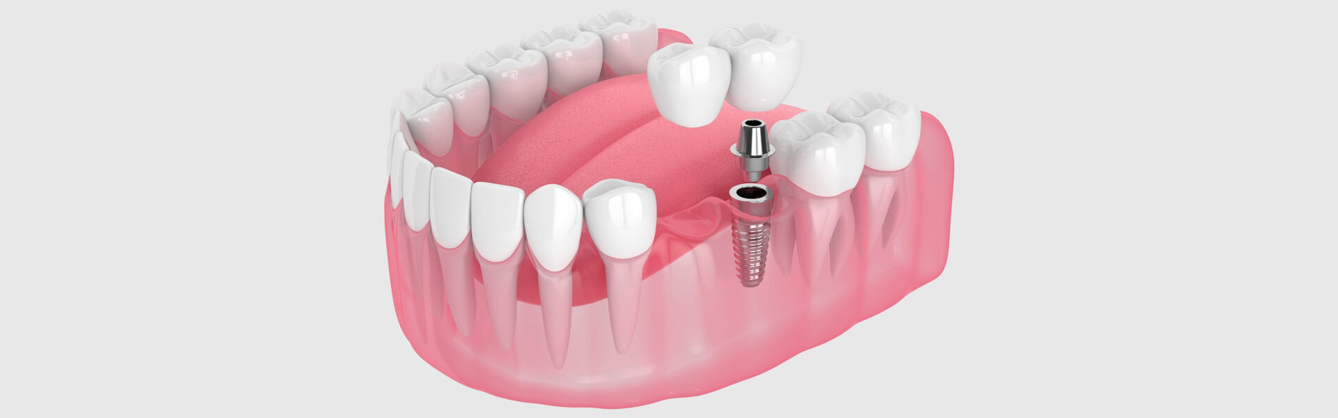 How Your Smile Can Be Restored with All-On-4®️ Dental Implants
