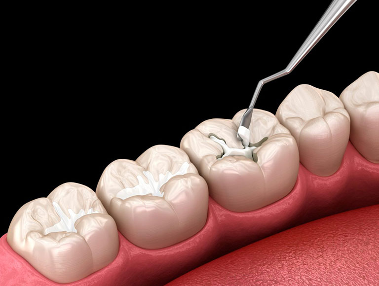 Dental Sealants