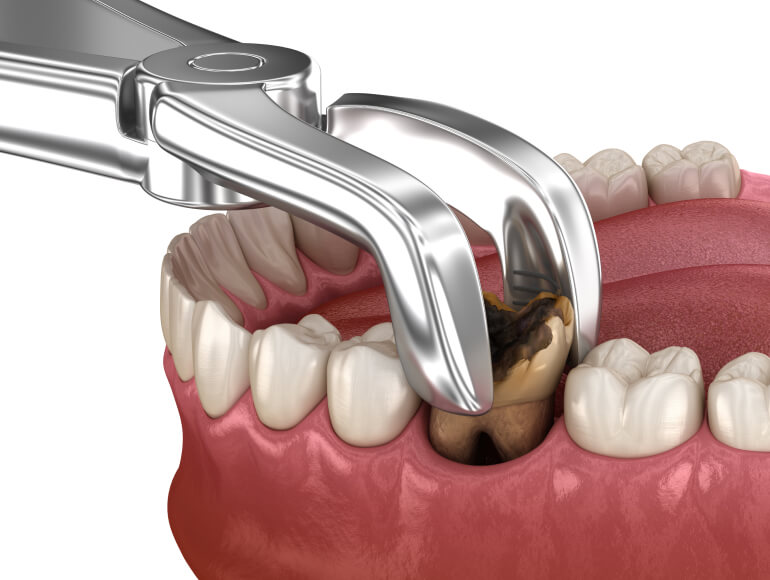 End Tooth Pain and Restore Comfort