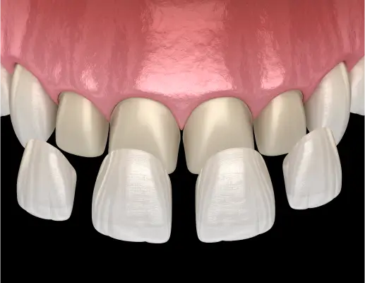 Dental Veneers